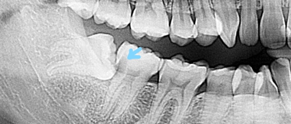 Deep Impacted Wisdom Tooth